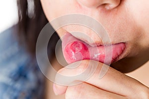 Woman with aphthous stomatitis photo