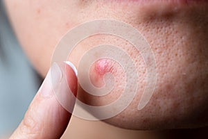 Woman apply cream on the acne.skin with pimple and pore. photo