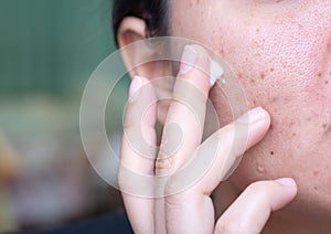 Woman applying cream onto face that has problem problematic skin , acne scars ,oily skin and pore, dark spots and blackhead and photo