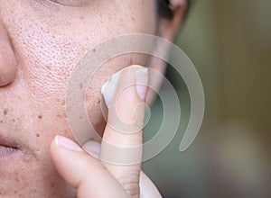 Woman applying cream onto face that has problem problematic skin , acne scars ,oily skin and pore, dark spots and blackhead and