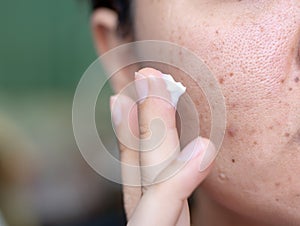 Woman applying cream onto face that has problem problematic skin , acne scars ,oily skin and pore, dark spots and blackhead and