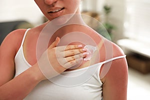 Woman applying cream on sunburn at home photo