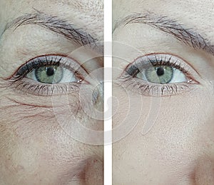 Woman bag eyes puffy wrinkles before and after rejuvenation treatment