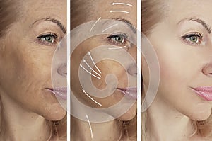 Woman beauty wrinkles before after medicine therapy procedures, tightening rrow