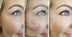 Woman beauty wrinkles removal difference treatment antiaging cosmetology before and after correction procedures