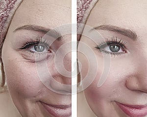 Woman beauty wrinkles removal lift antiaging cosmetology before and after correction procedures photo
