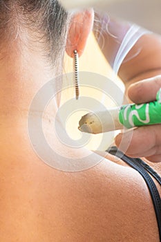 Woman being treated with acupuncture and moxibustion treatments