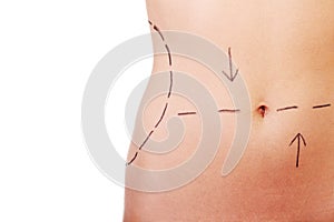 Woman belly marked out fo rcosmetic surgery.