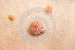 Woman with birthmark on her back, skin tags removal photo