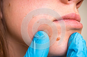 Woman with birthmark on her face, skin tags removal photo