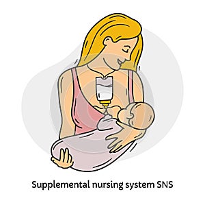 A woman breast-feeds a baby with supplemental nursing system SNS