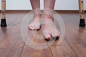 A woman after a broken leg to learn to walk. Rehabilitation after removal of plaster bandage.