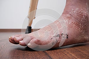 A woman after a broken leg to learn to walk. Rehabilitation after removal of plaster bandage.