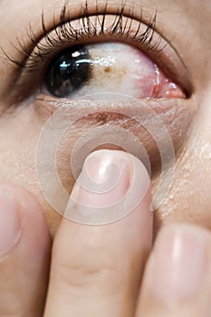 A Woman with Brown Spot on her Eye