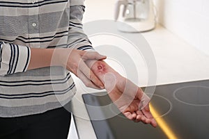 Woman with burn on her forearm in kitchen, closeup