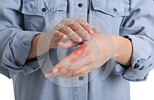 Woman with burn of her hand on white background, closeup photo