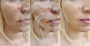 Woman caucasian face sagging aging contrast plastic mature effect tightening before after treatment