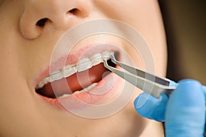 Woman with ceramic braces on teeth at the dental office