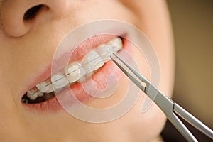 Woman with ceramic braces on teeth at the dental office