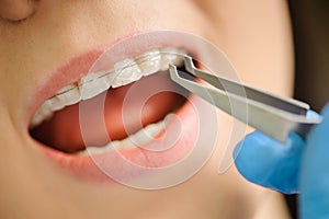 Woman with ceramic braces on teeth at the dental office