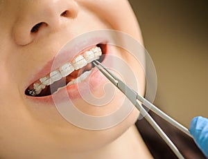 Woman with ceramic braces on teeth at the dental office