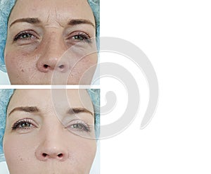 Woman circles skin   correction  therapy  facial  collage   effect tension lifting before after antiaging