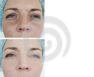 Woman circles skin   correction  therapy  facial  collage   effect tension lifting before after antiaging photo