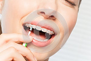 Woman cleaning braces using interdental brush photo