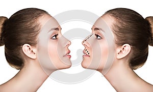 Woman before and after cosmetic nose surgery