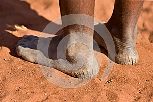 Woman with cracked heels in the sand