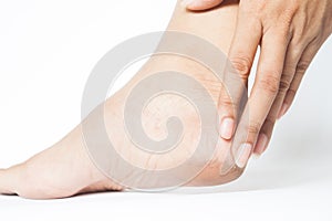 Woman cracked heels with white background, Foot healthy