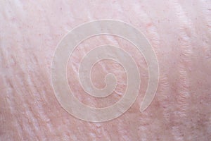 Woman with cracks on skin. Stretch marks and scars or striae gravidarum. Skin care concept photo
