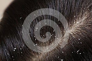 Woman with dandruff in her dark hair, closeup