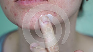 Woman with dermatology skin problem apply salve on big pimple at her face 4k