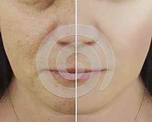 Woman difference wrinkles beautician pores results pigmentation face patient before and after lifting cosmetic procedures contrast