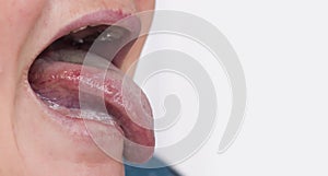 Woman with a disease and redness of the tongue. Glossitis and gingivitis disease concept, copy space photo