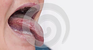Woman with a disease and redness of the tongue. Glossitis and gingivitis disease concept, copy space