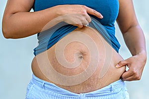 Woman displaying stretch marks after pregnancy