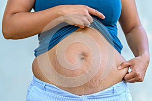 Woman displaying stretch marks after pregnancy photo