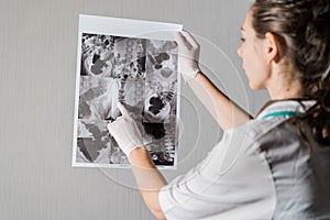 Woman doctor checking the intestine xray of dolichocolon person photo