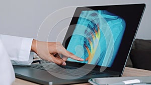 Woman Doctor showing x-ray with pain on the ribs on a laptop. Slow motion