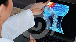 Woman doctor showing a x-ray of skull with pain in the brain on a laptop. View over the shoulder