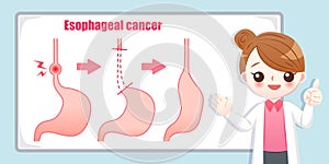 Treatment of esophageal cancer photo