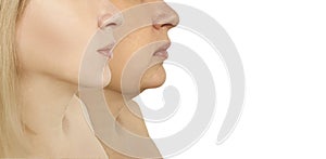 Woman double chin facelift tightening sagging before after problem oval liposuction collage procedures