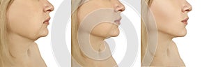 Woman double chin facelift tightening loss sagging before after problem oval liposuction collage procedures photo