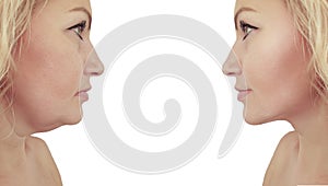 Woman double chin sagging lifting correction tightening treatment before and after procedures