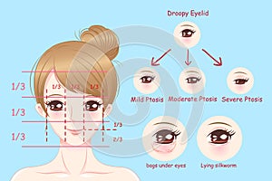 Woman with droopy eyelids photo