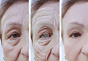 Woman elderly face skin wrinkles rejuvenation contrast before and after procedures, arrow