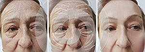 Woman elderly face wrinkles hydrating cosmetology rejuvenation before and after procedures, arrow