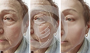 Woman elderly face wrinkles correction mature contrast before and after procedures, arrow